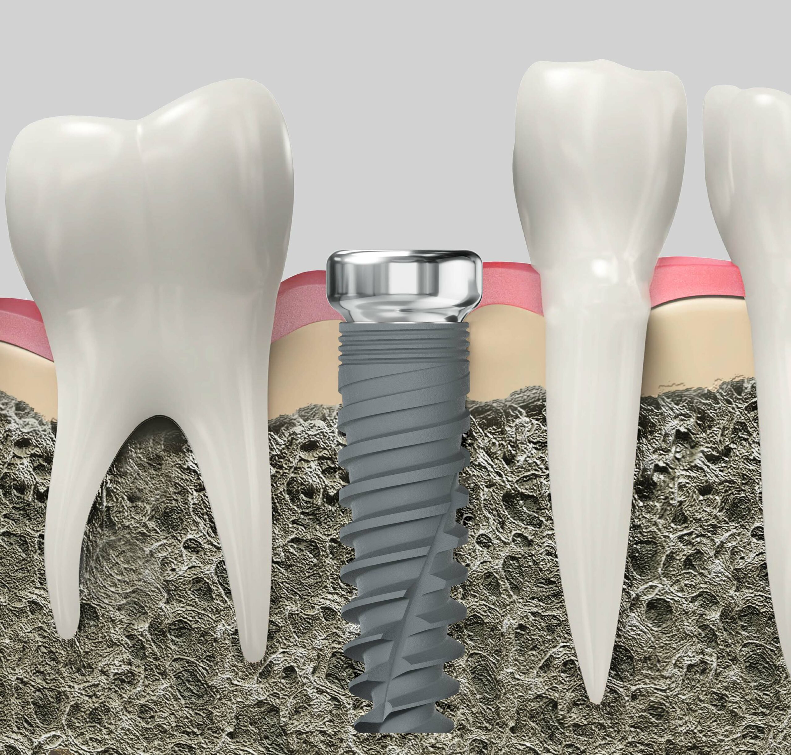 healing-abutment Healing Abutment in usage Illustration